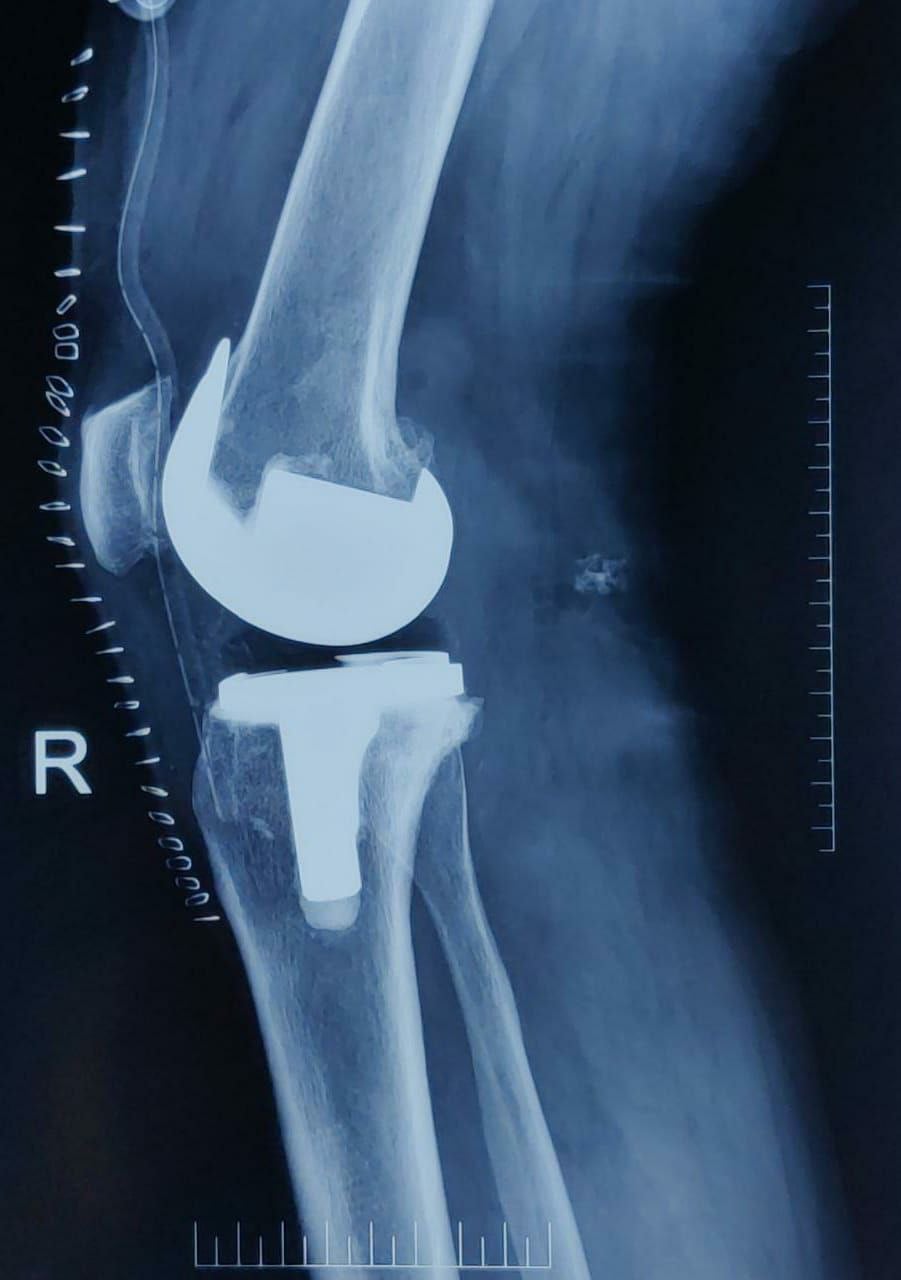Post-Operative Outcome