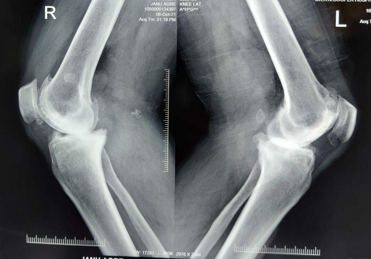 Pre-Operative X-ray