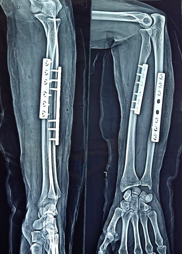 Post-Operative Outcome