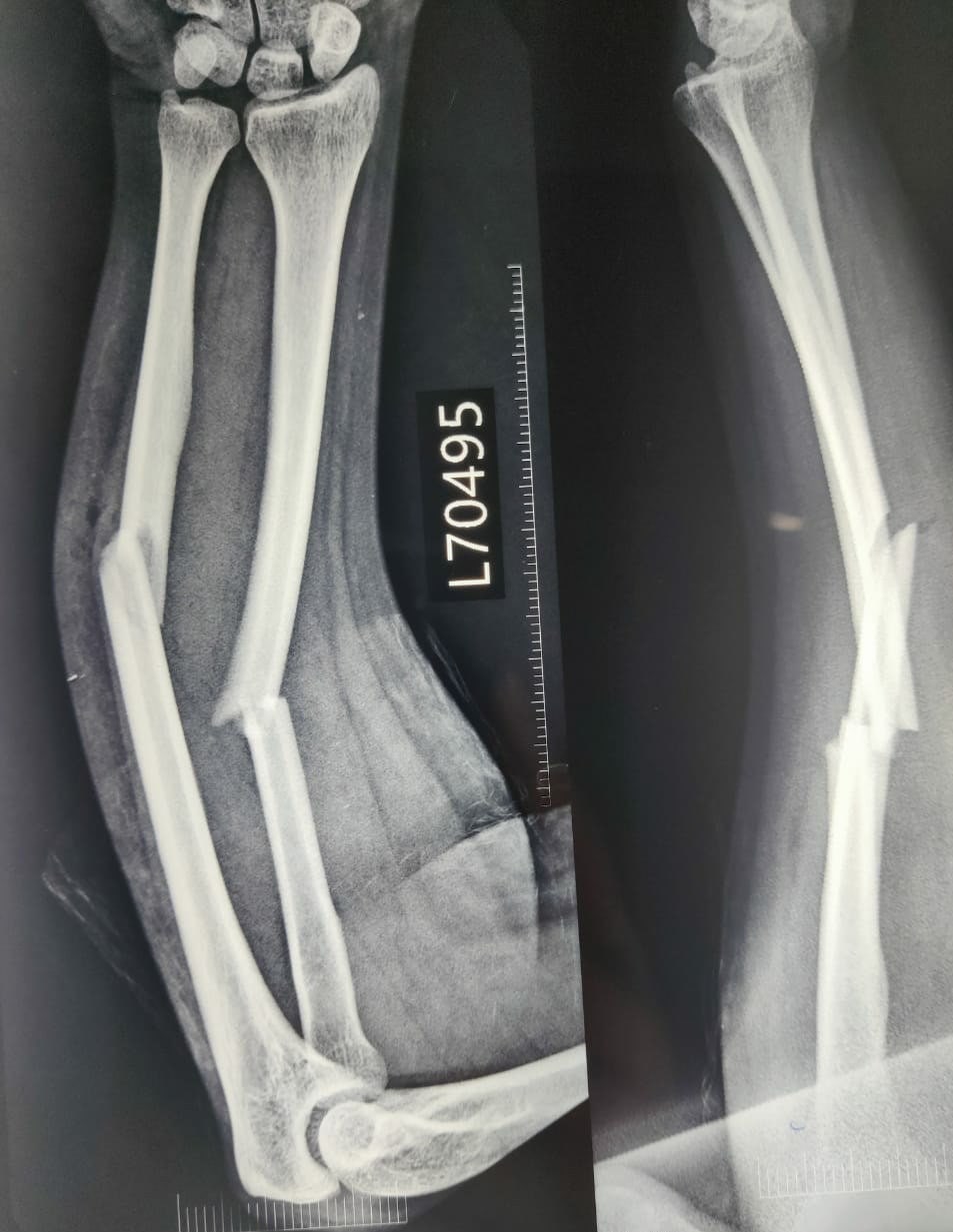 Pre-Operative X-ray