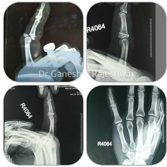 Pre-Operative X-ray