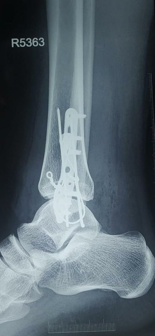 Post-Operative Outcome